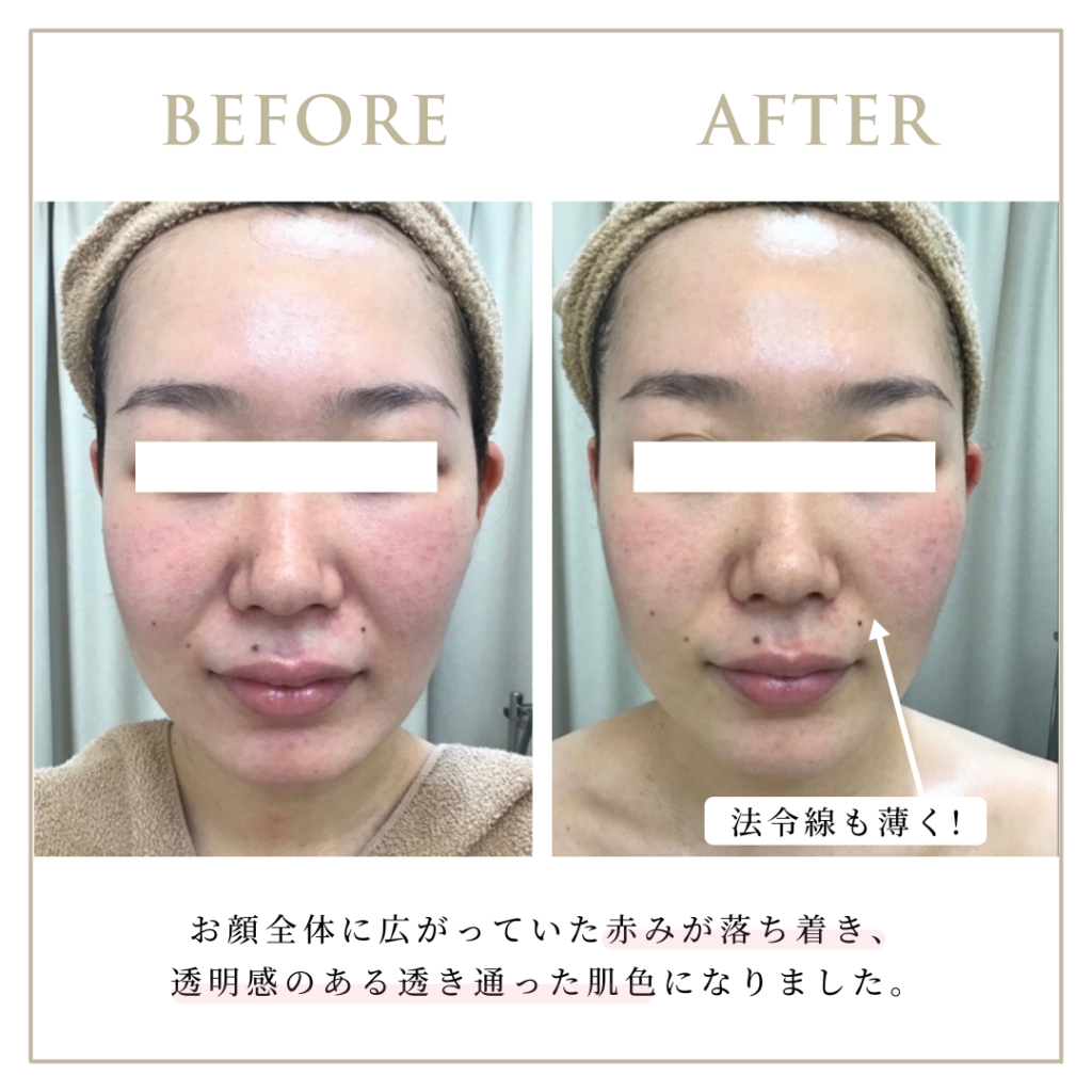 赤ら顔_比較